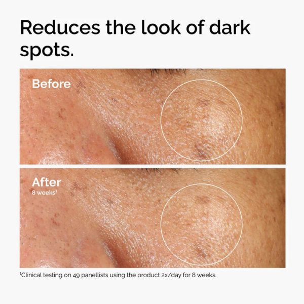 ord-alpha-arbutin-before-after-dark-spots